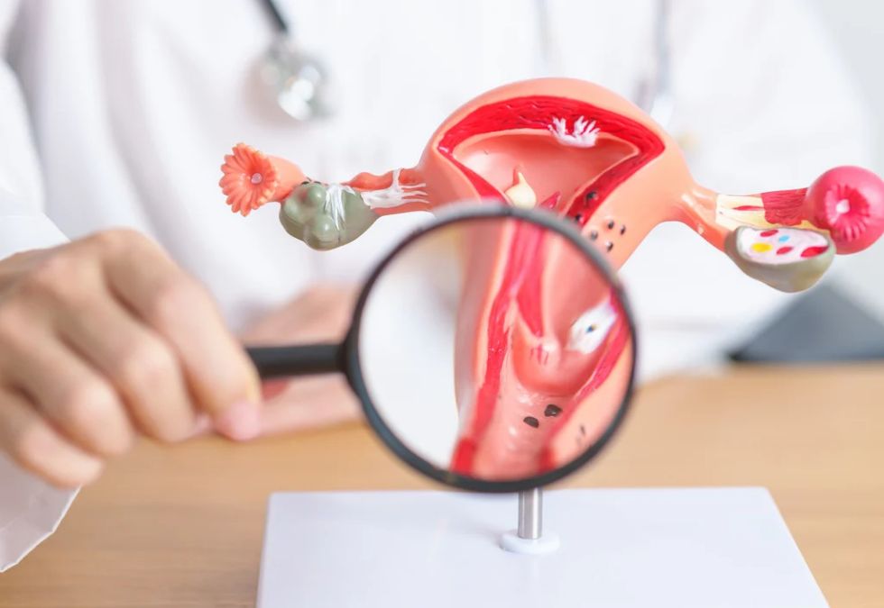 Endometriosis